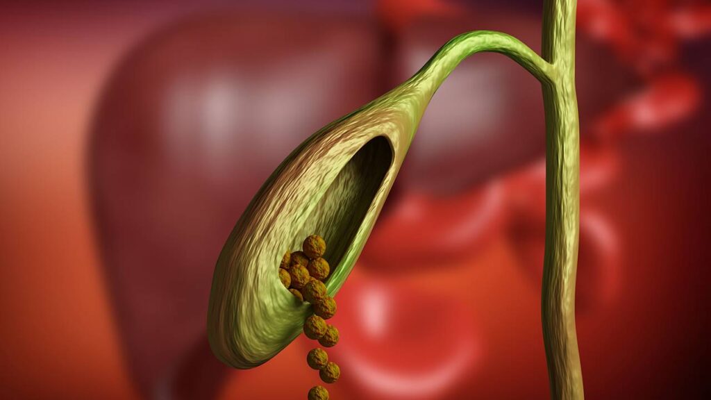 Factores que influyen en la formación de cálculos biliares