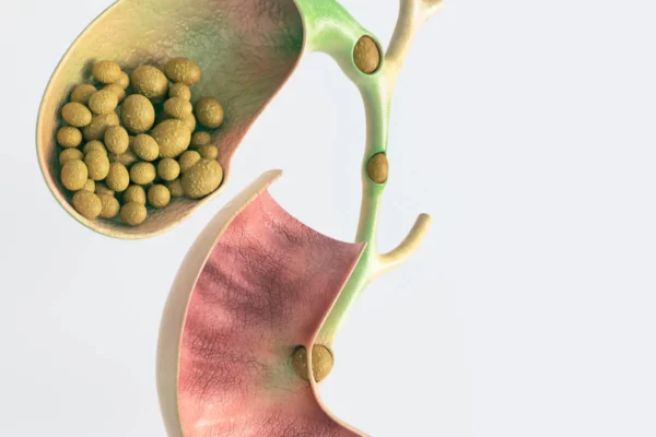 Factores de riesgo para enfermedad por cálculos bilares