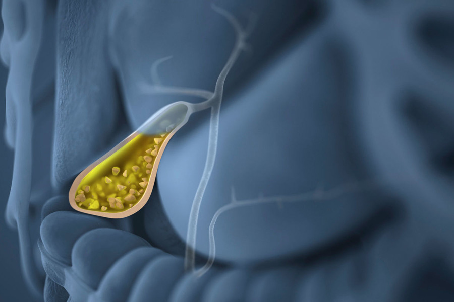 Factores de riesgo para padecer enfermedad por cálculos biliares