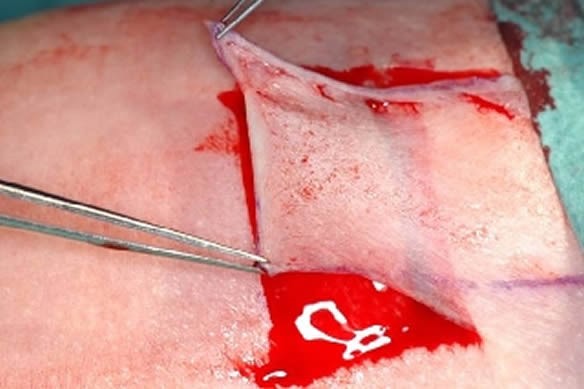 ¿Cuáles son los tipos de injertos utilizados en quemaduras?