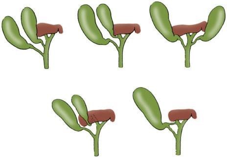 Variantes anatómicas de la vesícula y vías biliares