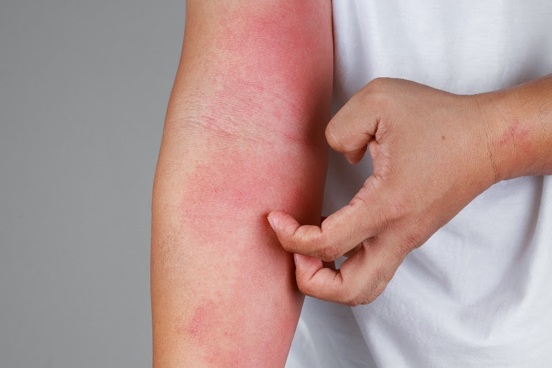 ¿Cómo se manifiesta la dermatitis atópica?