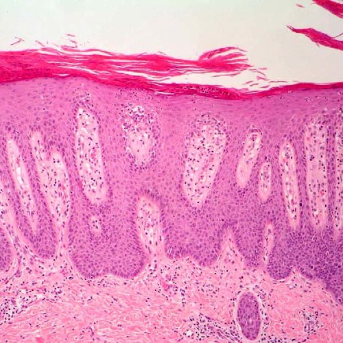 ¿Cuáles son las características histológicas de la psoriasis?