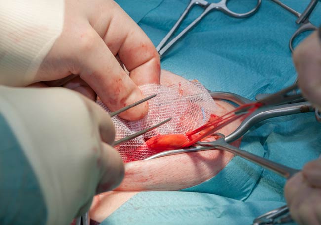 ¿Cómo es la técnica de Lichtenstein para reparación de hernia inguinal?