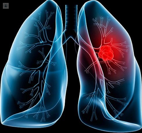 ¿Qué son los abscesos pulmonares?