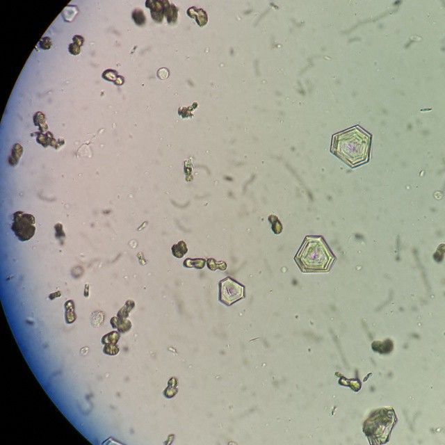 ¿Qué es la cistinuria?