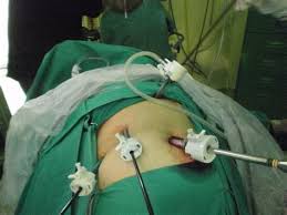 ¿Cuándo se indica tratamiento en pacientes con colelitiasis asintomática?