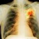¿Cómo se forman los abscesos pulmonares?