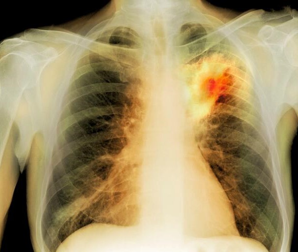 ¿Cómo se forman los abscesos pulmonares?