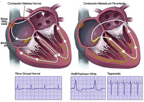 ¿Qué son las vías de conducción accesorias del corazón?
