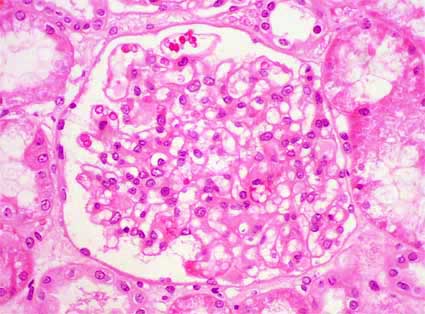 enfermedad renal de cambios mínimos