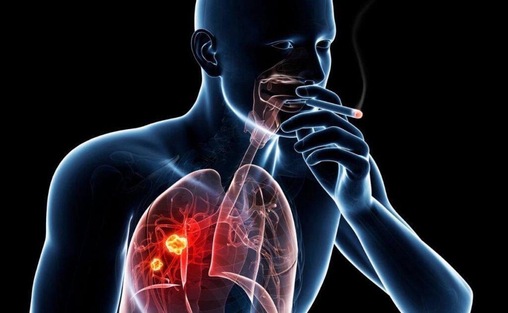 ¿Cuáles son los factores de riesgo para cáncer pulmonar?