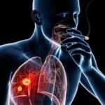 ¿Cuáles son los factores de riesgo para cáncer pulmonar?