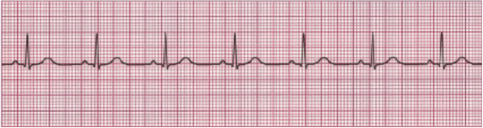 ¿Cuáles son las causas de taquicardia y bradicardia con ritmo sinusal?