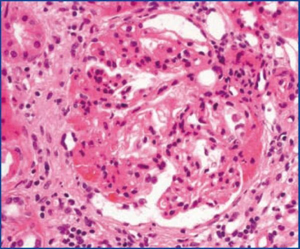 glomeruloesclerosis segmentaría focal