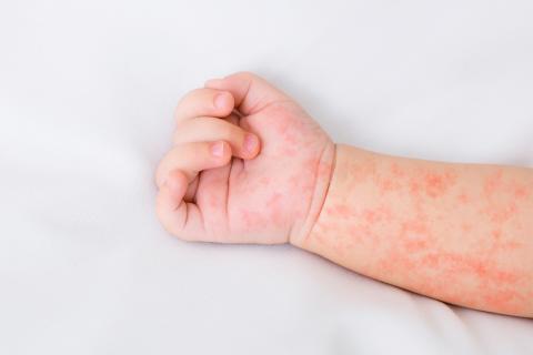 ¿Qué es la rubéola?