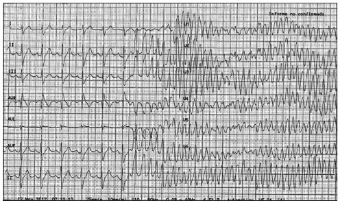 ¿Qué es una tormenta eléctrica o tormenta de taquicardia ventricular??