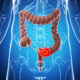 Factores de riesgo para cáncer de colon