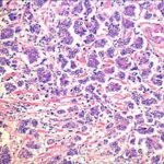 ¿Cuáles son los tipos de colangiocarcinoma por su forma de crecimiento?