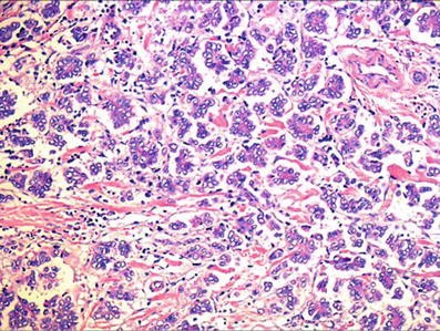 ¿Cuáles son los tipos de colangiocarcinoma por su forma de crecimiento?