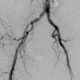 ¿Qué es la enfermedad oclusiva de las arterias iliacas?