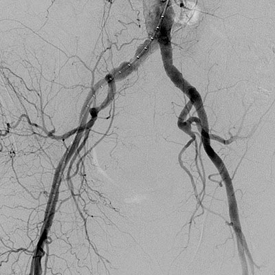¿Qué es la enfermedad oclusiva de las arterias iliacas?