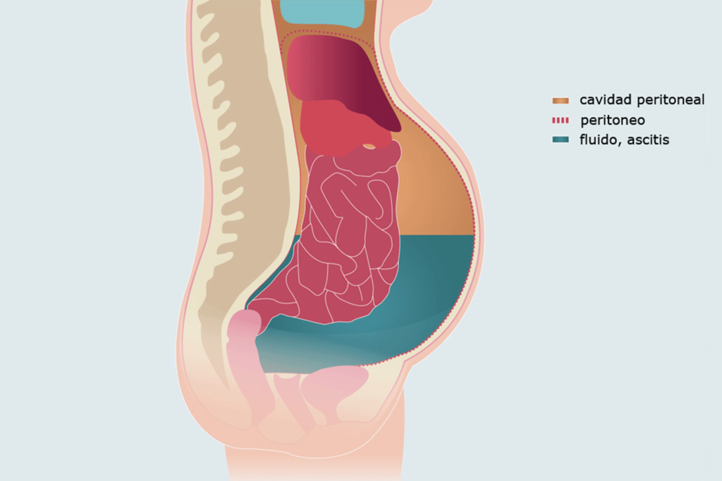¿Qué es la peritonitis primaria?