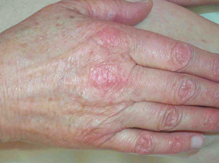 ¿Cómo se manifiesta la dermatomiositis?