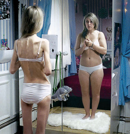 ¿Qué es la anorexia nerviosa?