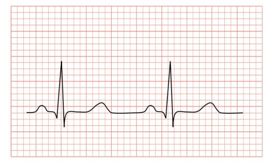 ¿Qué partes componen el trazo de un electrocardiograma normal?