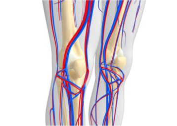Enfermedad oclusiva arterial femoral y popitlea