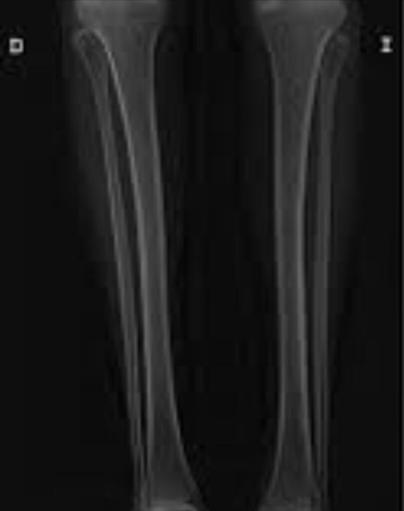 ¿Qué es la osteomalacia?