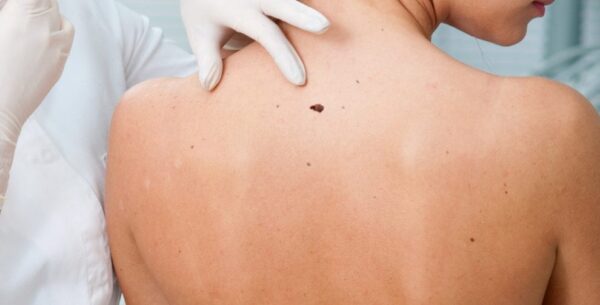 ¿Qué es el melanoma maligno?