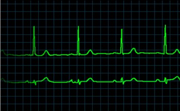 ¿Cuáles son los ritmos sinusales anormales?