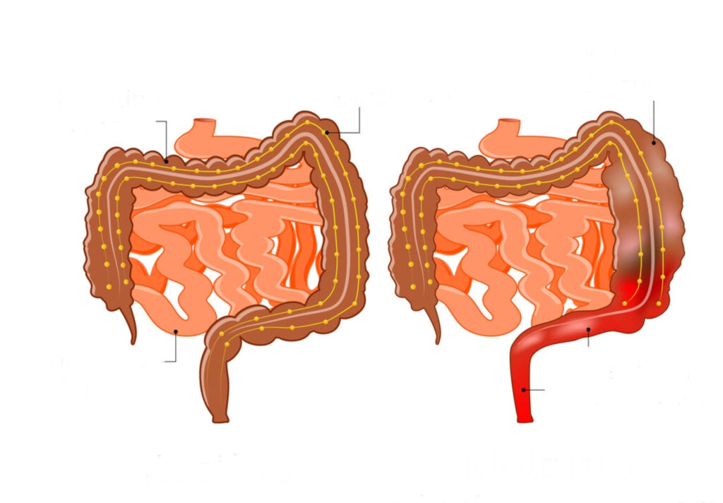 ¿Qué es la enfermedad de Hirschsprung?