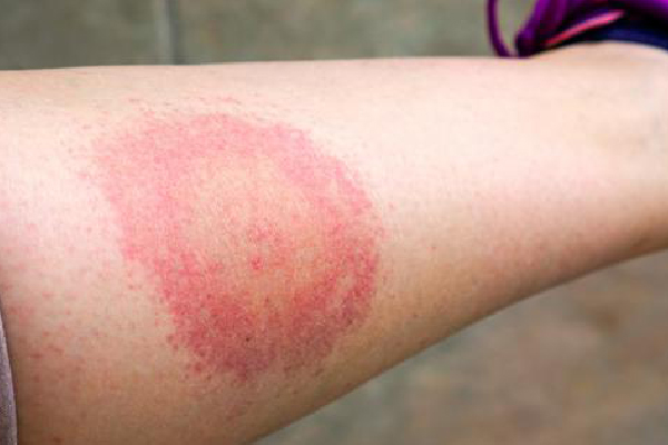 ¿Qué es la enfermedad de Lyme?