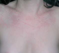 ¿Qué es la enfermedad de Still?