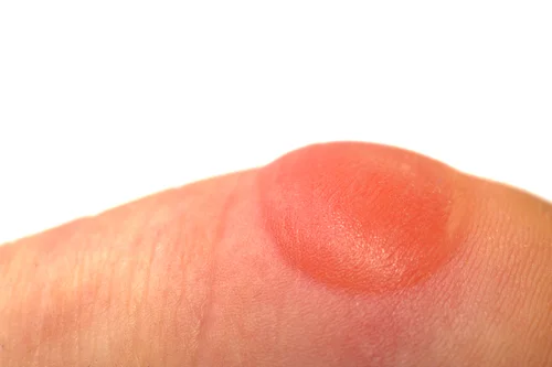 ¿Qué es una ampolla?