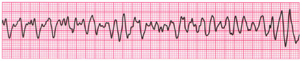 ¿Qué es la fibrilación ventricular?
