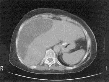 ¿Cómo se manifiesta un biloma?