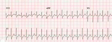 ¿Qué es una taquicardia paroxística?