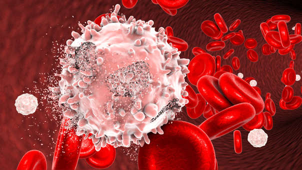 ¿Qué es síndrome de lisis tumoral?