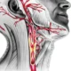 ¿Qué es la arteriopatía carotídea?