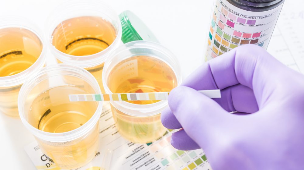 ¿Qué es la proteínuria?