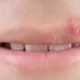 ¿Qué es el herpes labial?