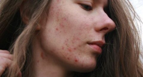 Epidemiología del acné