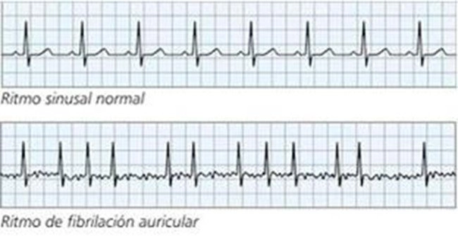 ¿Qué es la fibrilación auricular?