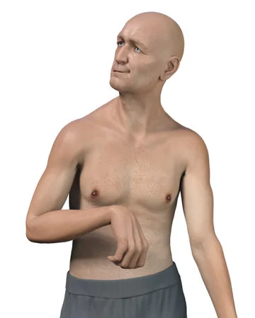 ¿Qué es la enfermedad de Huntington?