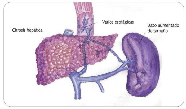Hipertensión portal en cirrosis hepática