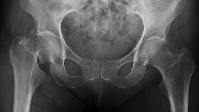 Fracturas por osteoporosis en mujeres menopáusicas